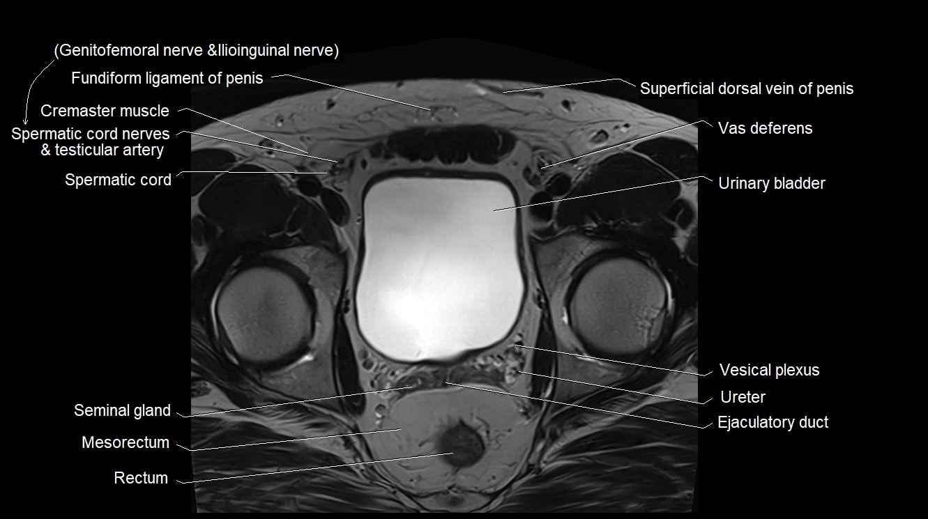 MRI 3T scrotum and penis axial cross sectional anatomy image 1.webp